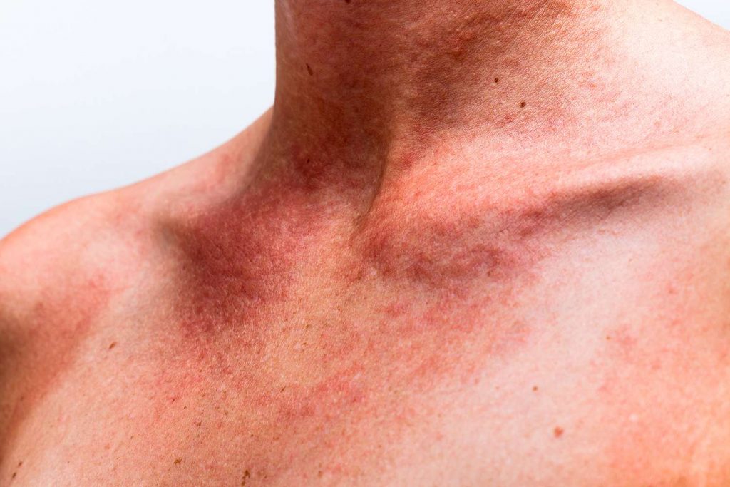 eczema che cose cause sintomi e cure