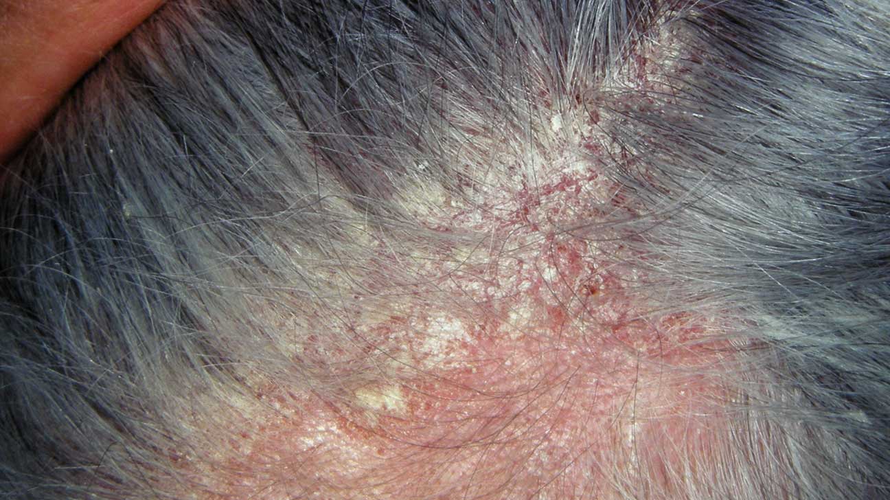 Dermatite Seborroica Che Cosè Sintomi Cause E Come Diagnosticarla